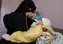 Onu, malnutrizione minaccia metà bambini sotto 5 anni nello Yemen
