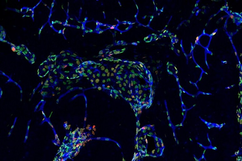 Colorazione istologica delle cellule endoteliali di un cavernoma cerebrale (fonte: Ifom-Università di Milano) - RIPRODUZIONE RISERVATA