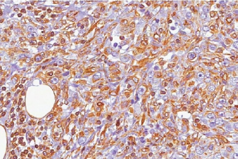 Campione di tumore del seno con alti livelli di microRNA miR-146a e miR-146b (fonte: Nicassio,Tordonato, IIT) - RIPRODUZIONE RISERVATA