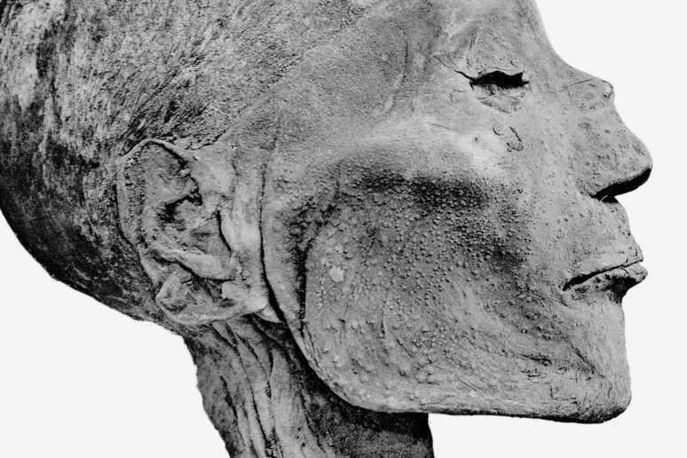 I segni del vaiolo sul volto della mummia di Ramses V (fonte: G. Elliot Smith) - RIPRODUZIONE RISERVATA