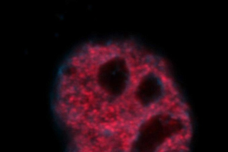 Cellule di carcinoma della cervice uterina trattate con un farmaco chemioterapico che induce un danno al Dna. In rosso il Dna danneggiato, in blu il DNA totale (fonte: A. Giordano, Temple University) -     RIPRODUZIONE RISERVATA